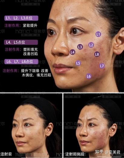 目前国内拿到批文的童颜针只有两款,awl和rbts,出于效果保证和安全性