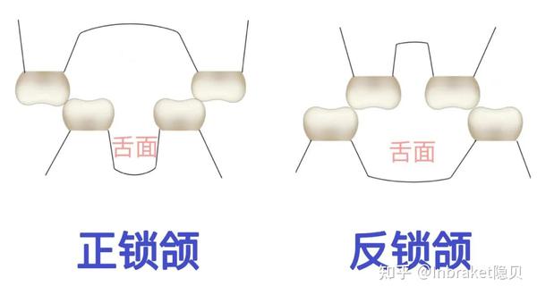 什么是正畸颌垫?为什么矫牙需要粘颌垫? - 知乎