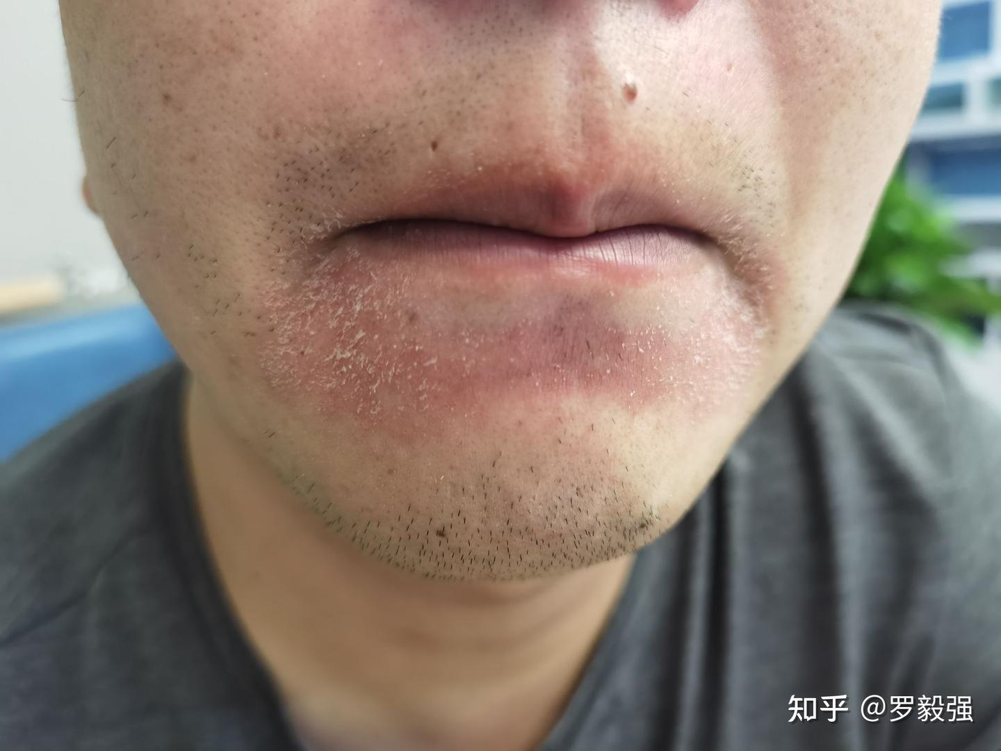 已经多年了,不知道算不算是口周皮炎 - 知乎