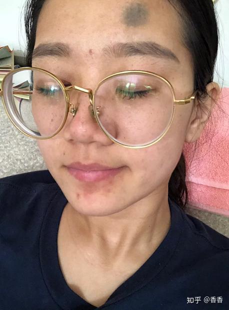 角质层厚有什么危害事实上不仅衰老加快皮肤还会越来越黄