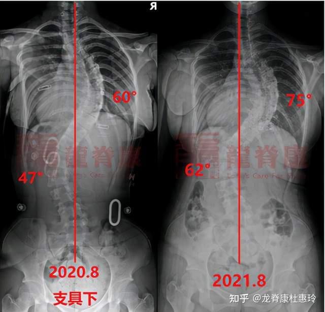 脊柱侧弯在青春期发展迅速,不抓紧治疗会发生什么问题? - 知乎
