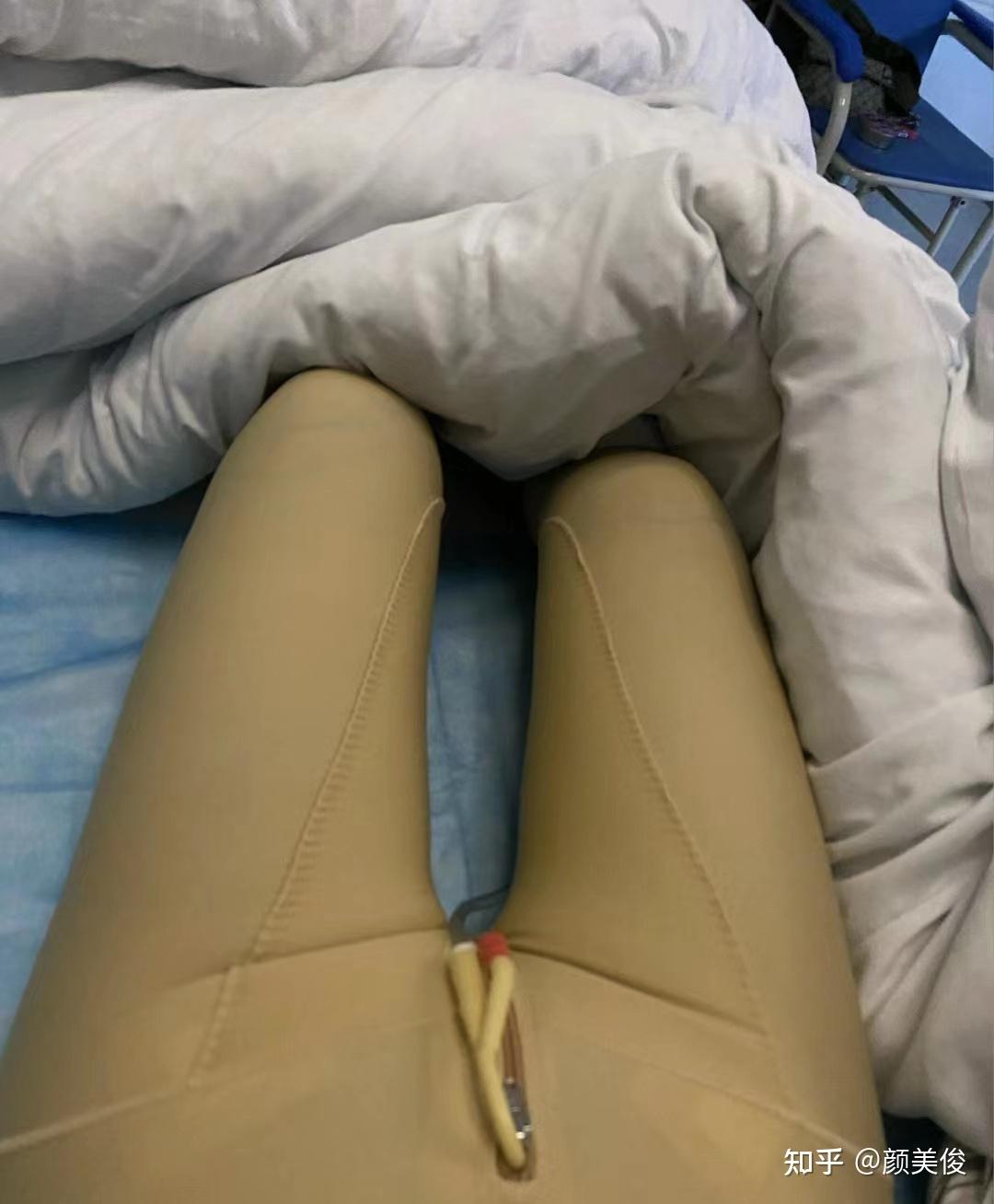 成都大腿环吸案例分享;术后1个月恢复照片