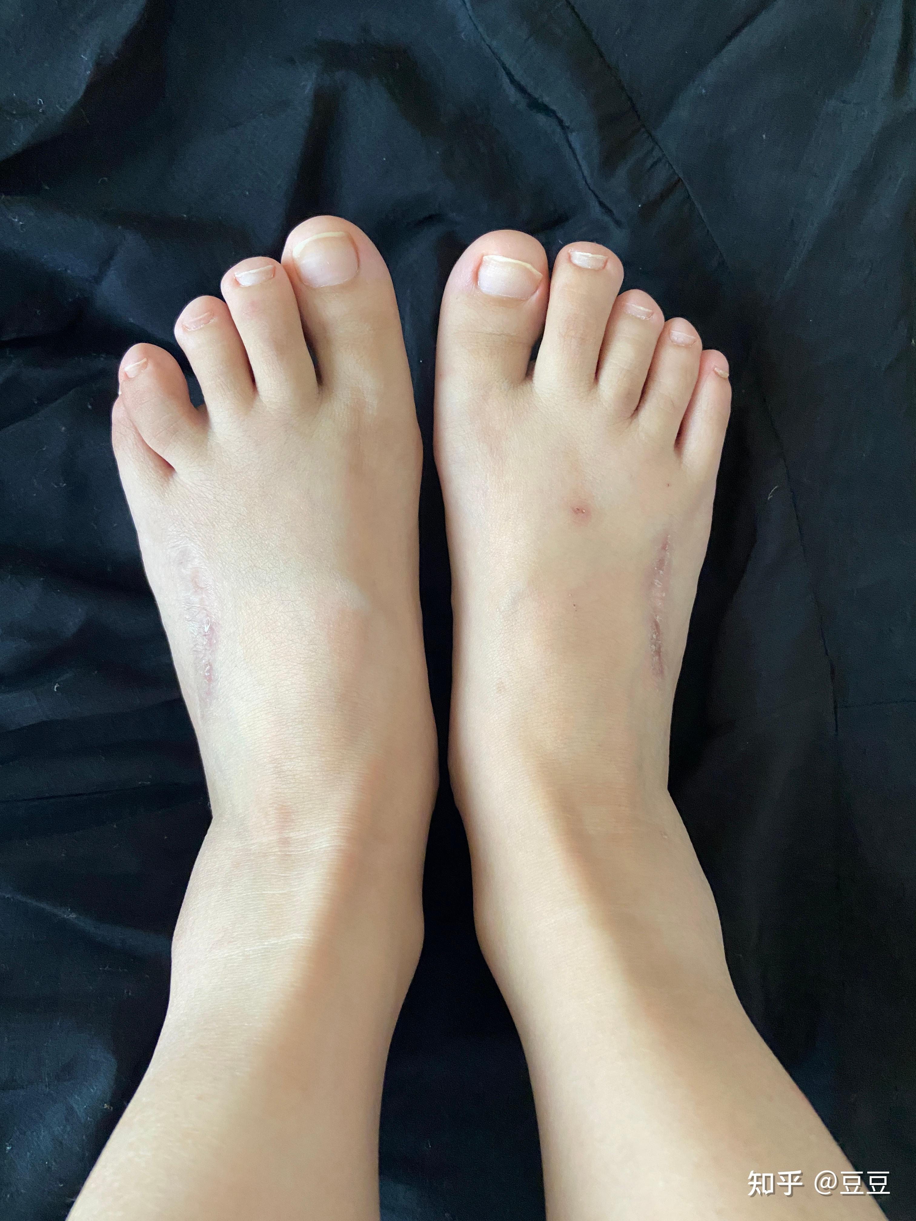 第四脚趾短小症手术有没有风险?