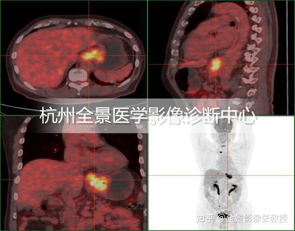 PET/MR在胃癌伴肝转移的案例分享 - 知乎