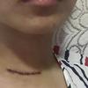 25岁肿瘤医院护士分享甲状腺癌淋巴转移经历 坚强面对 勇敢生活 知乎
