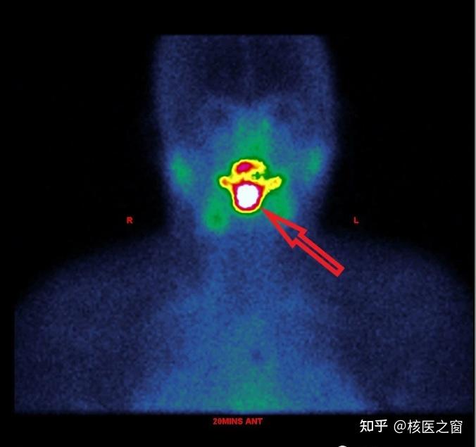 甲状腺生病，核医学来帮忙！ - 知乎