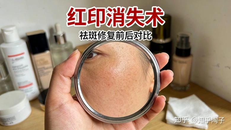 祛斑掉痂后的红印会变成斑吗?白白兔教你怎么修复 - 知乎