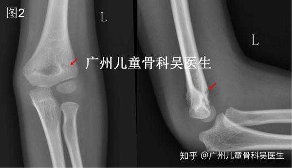 孩子意外损伤导致肱骨髁上骨折 家长该怎么办 肱骨髁上骨折功能锻炼 五品网