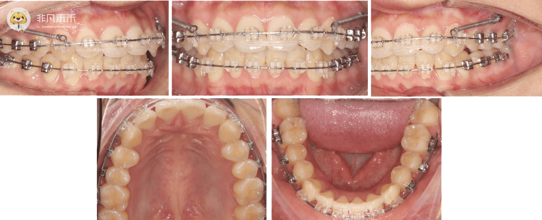 正畸病例牙不齊前牙凸不拔牙矯治病例1例