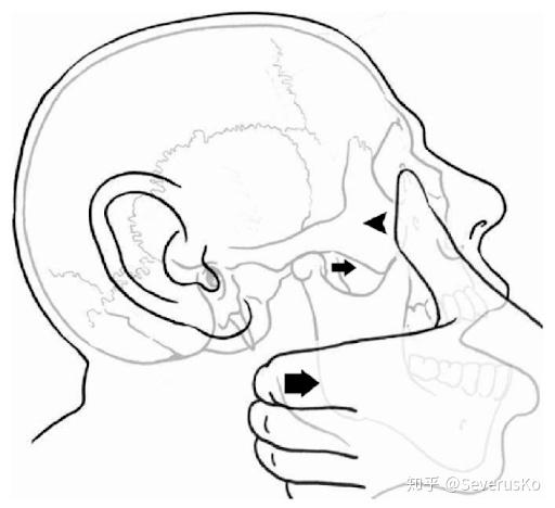 人的下巴脱臼示意图图片