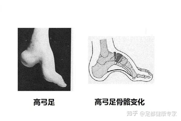 身边有高弓足的人要注意了 一定要转给身边的人看 知乎