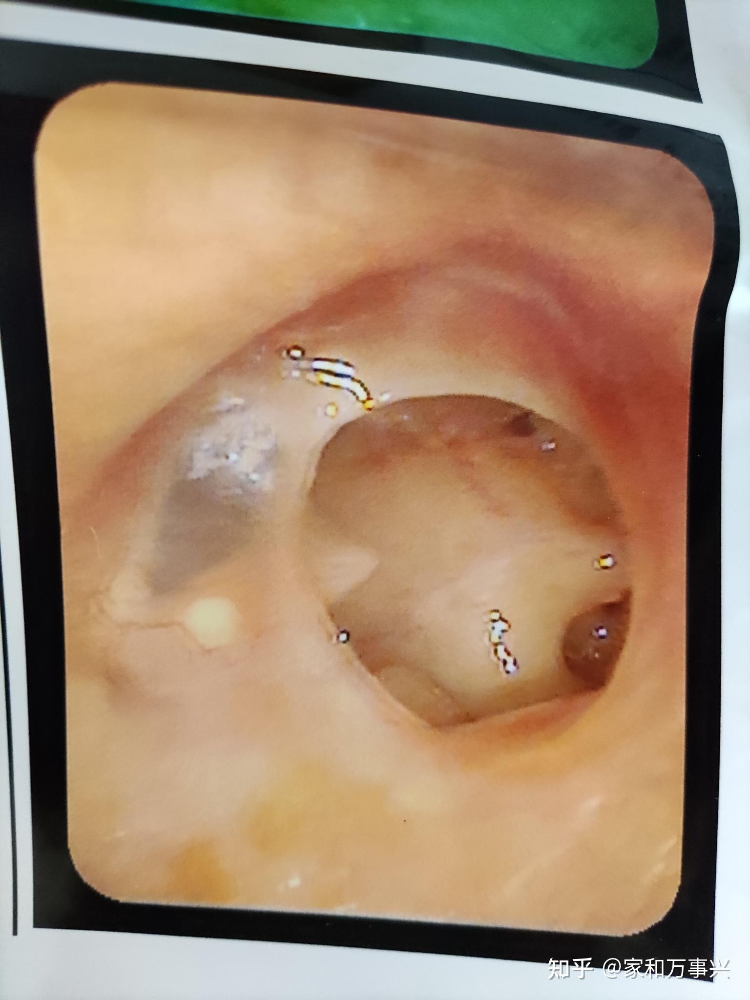 耳膜穿孔手术图片