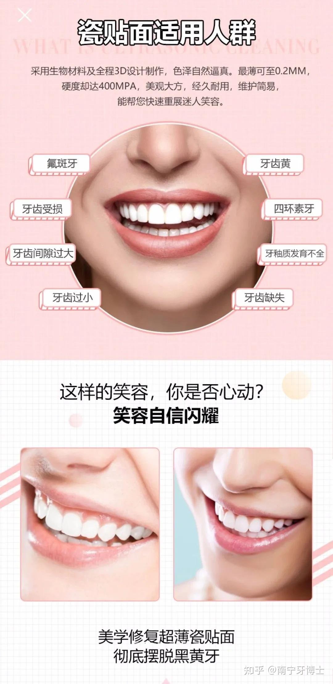 牙齿贴面的的优势在哪为什么越来越受欢迎