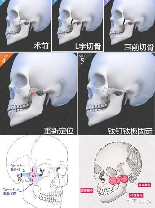 颧骨内推示意图图片