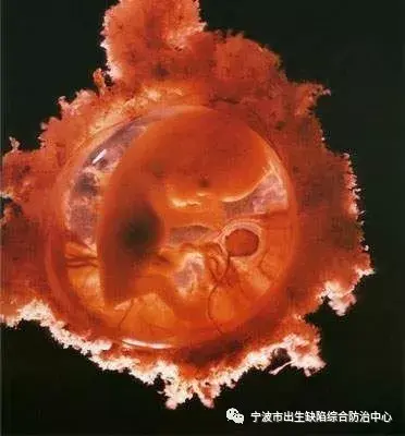 3,胎儿鼻骨发育异常 胎儿鼻骨发育异常对筛查唐氏综合征胎儿也有重要