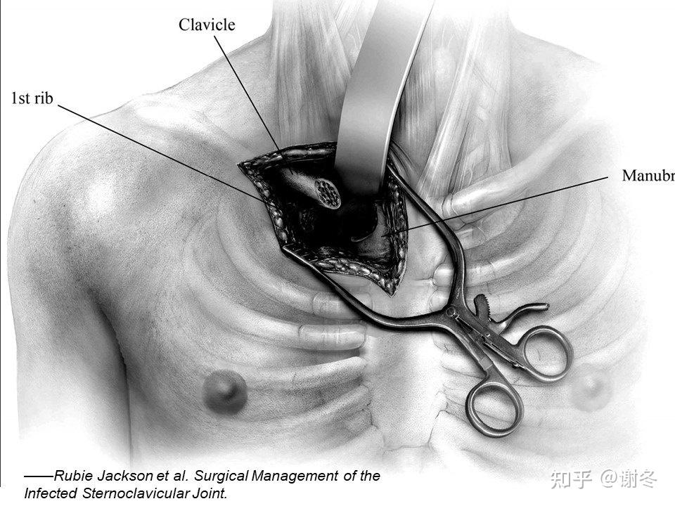 胸锁关节感染的外科治疗