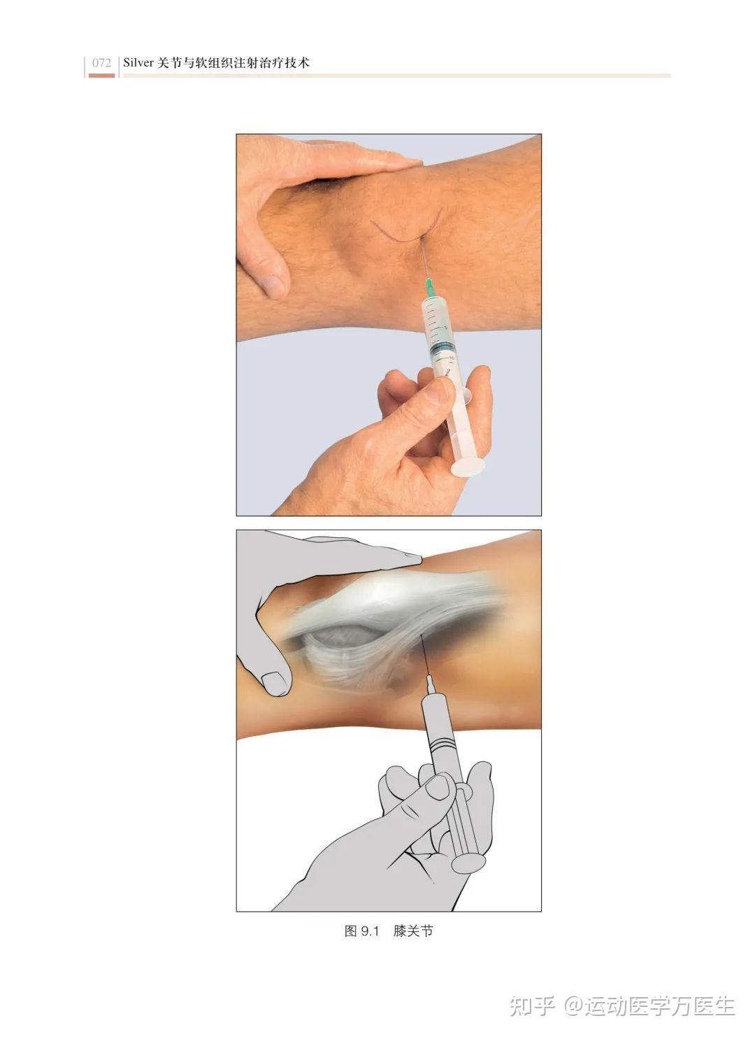 运动员打的封闭针是什么