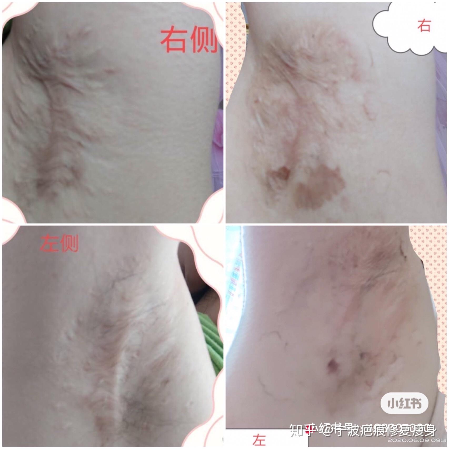 腋下疤痕修复后的效果