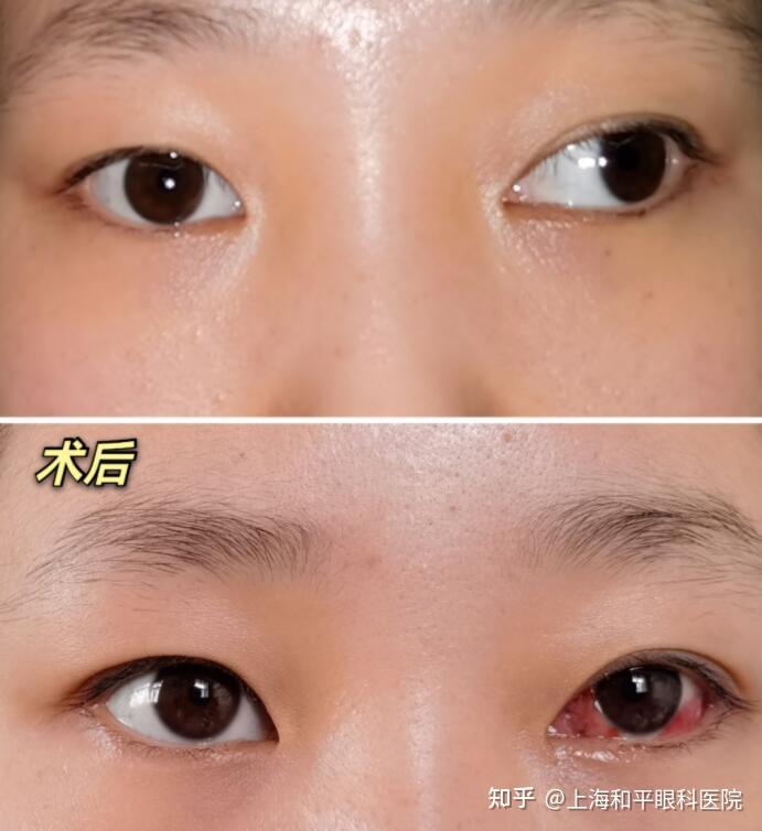 小孩眼睛有点斜视怎么治疗?是选择手术还是配镜? - 知乎