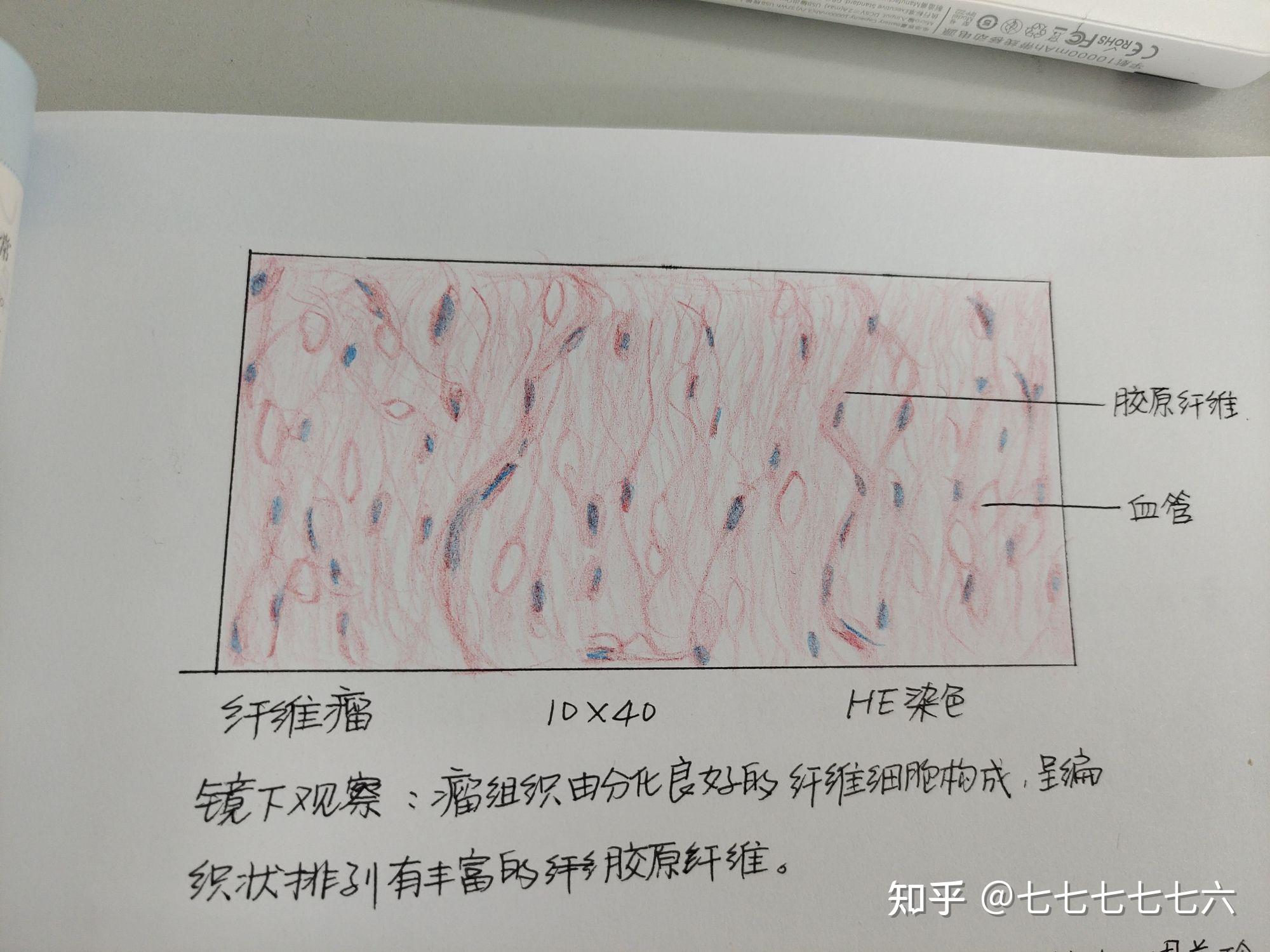 纤维肉瘤绘图图片