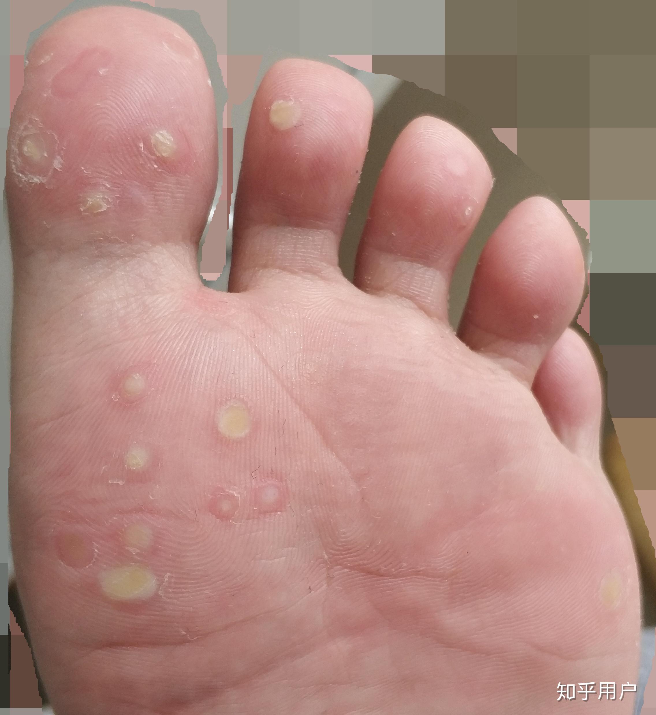 关注问题 67 写回答 登录/注册 皮肤科 皮肤病 疣 跖疣 治疗脚上的