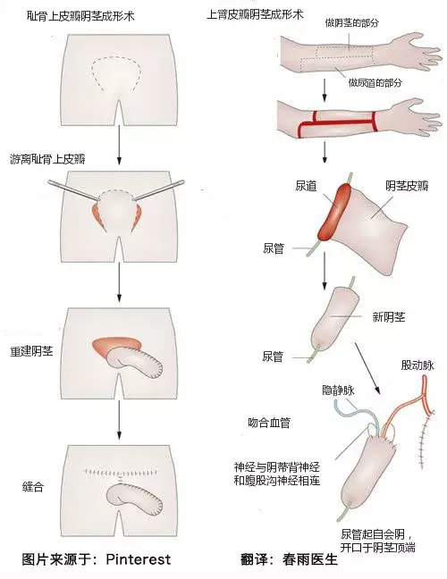 女变男手术时的那活儿是怎么无中生有的