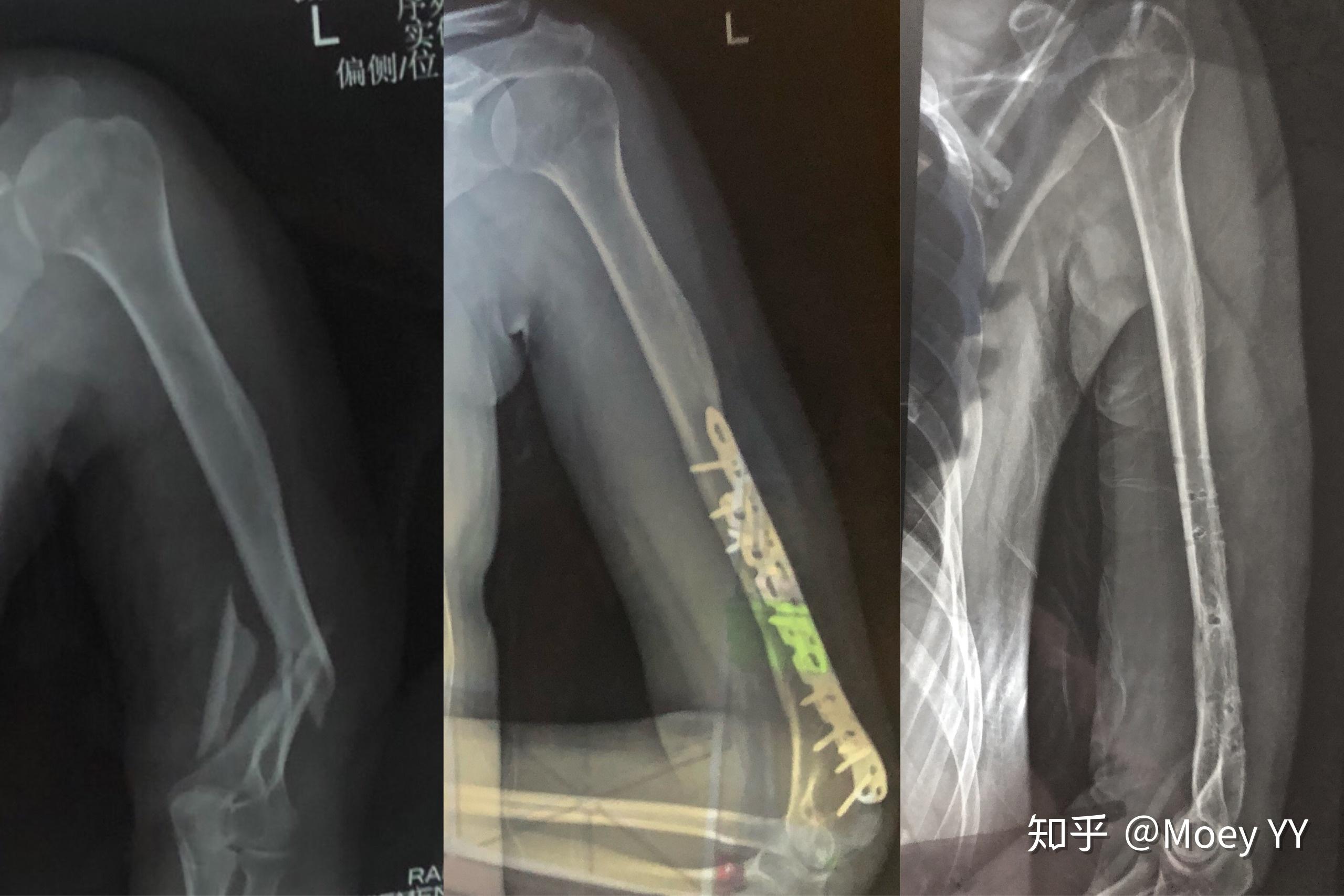 第五掌骨基底骨折--克氏针+钢板固定治疗术 - 知乎