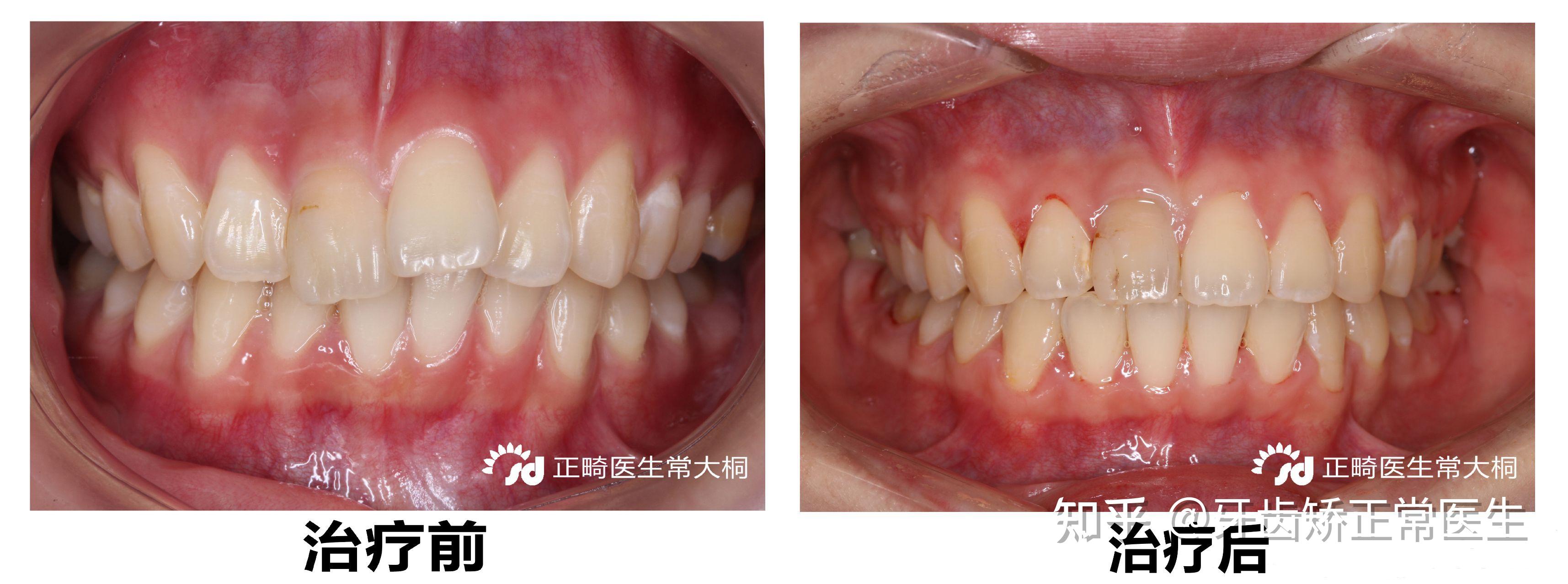 郑州隐适美矫正常大桐