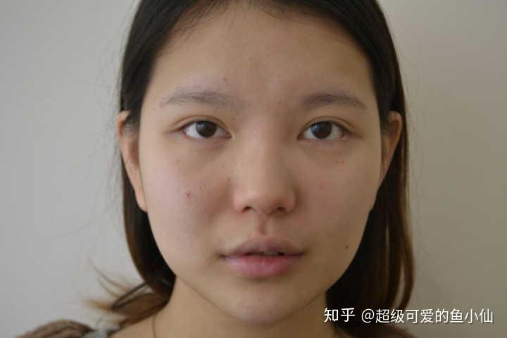 整形老司机告诉你玻尿酸隆鼻后鼻子会变宽是真的