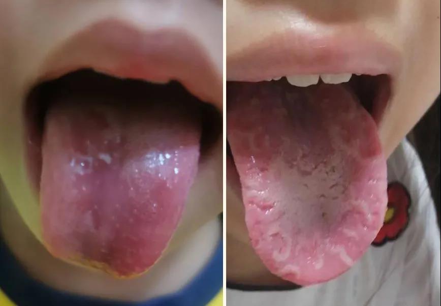 地图舌的孩子通常有两种 ●舌体胖,舌质淡,舌面较湿润的花剥苔 这类型