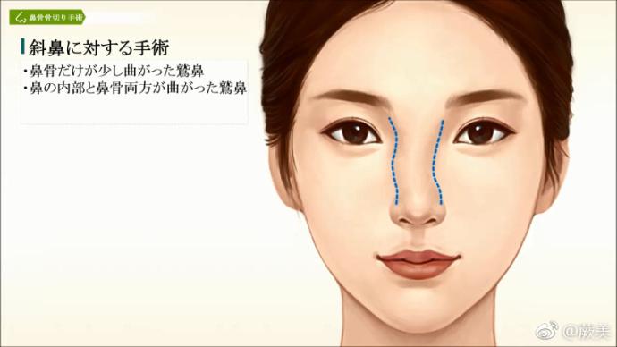 关于歪鼻的正确对应方式 知乎