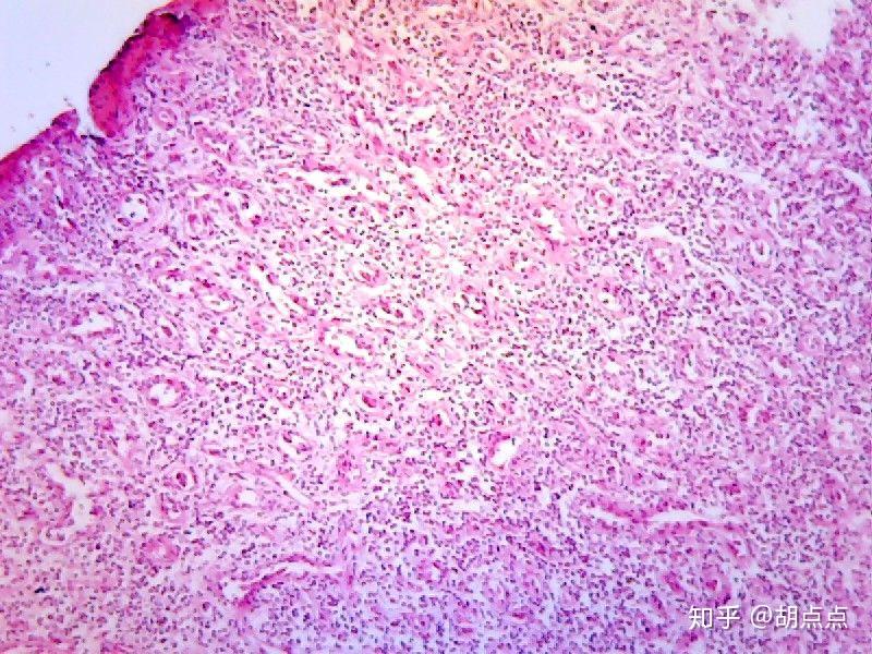 肾近曲小管上皮细胞水肿,肝细胞脂肪变性,肉芽组织,混合血栓,慢性肝