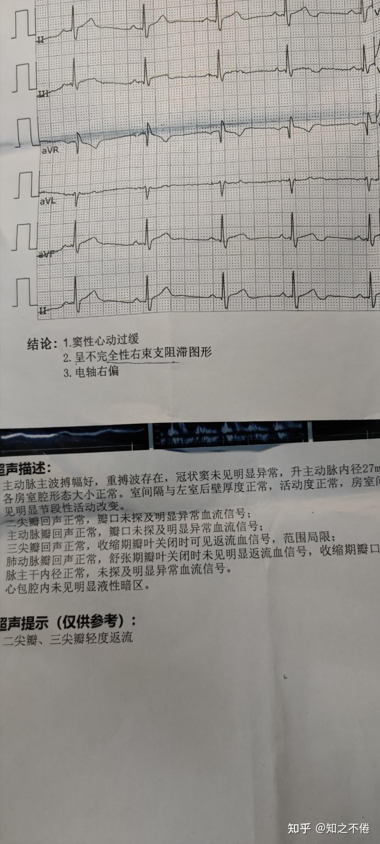 浙江省人民医院心脏检查心率不齐