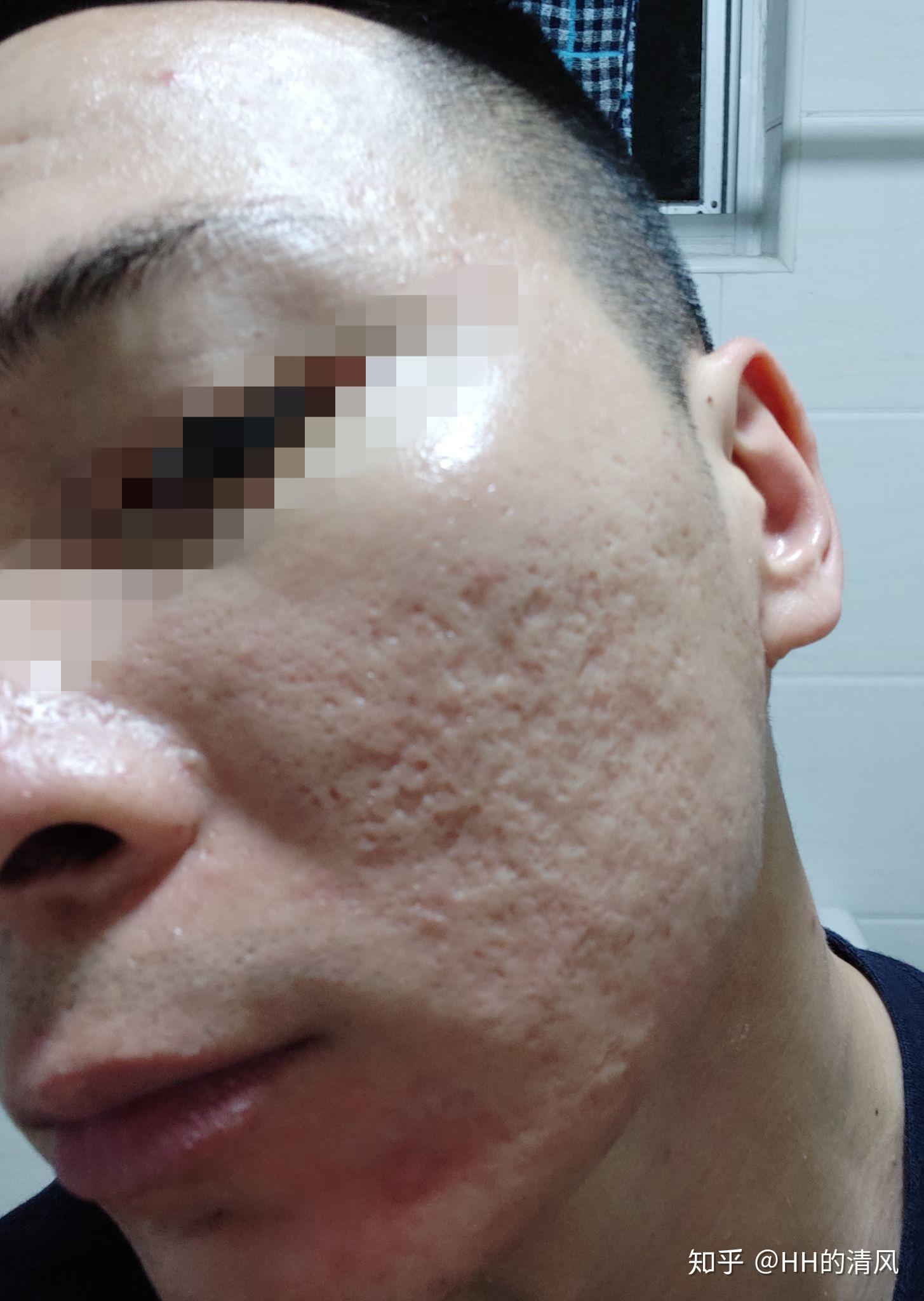 6月24日更新第二次记录剥脱性点阵激光祛痘坑3月8日做了第一次