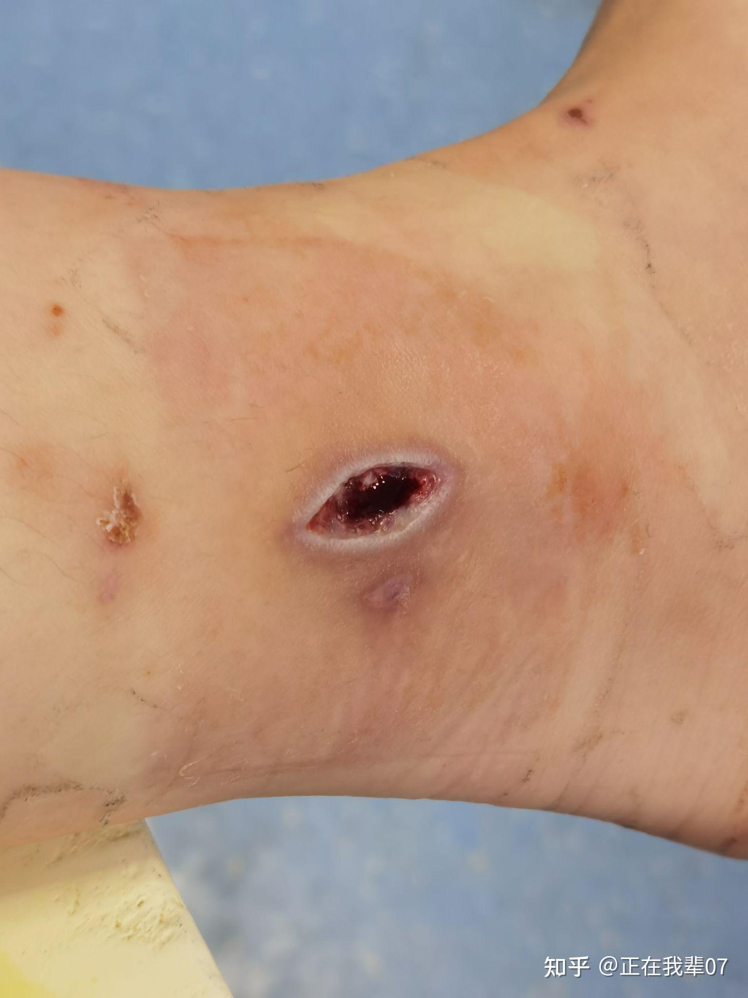 热水袋低温烫伤记录图片