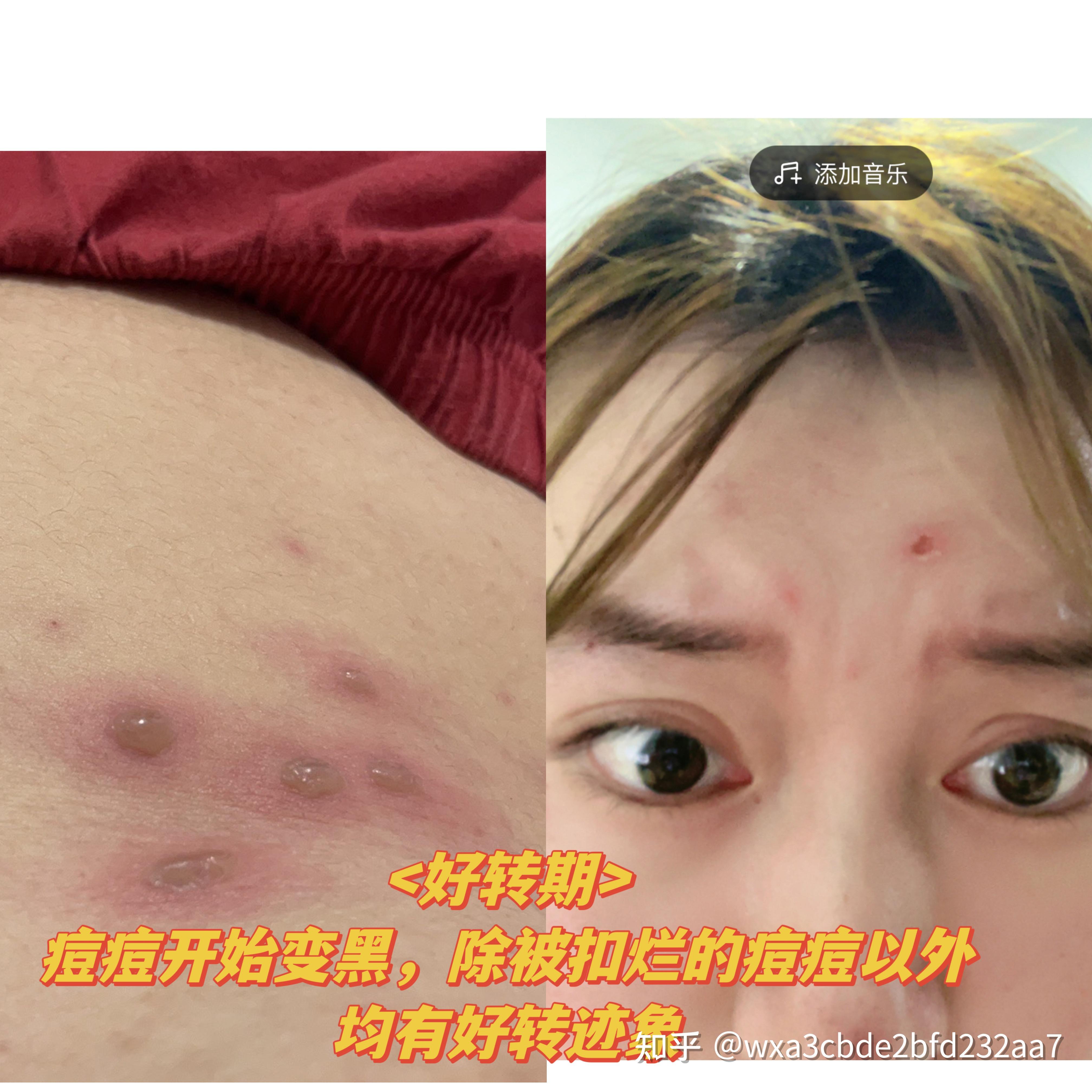 成人水痘经验贴—炼狱般的体验