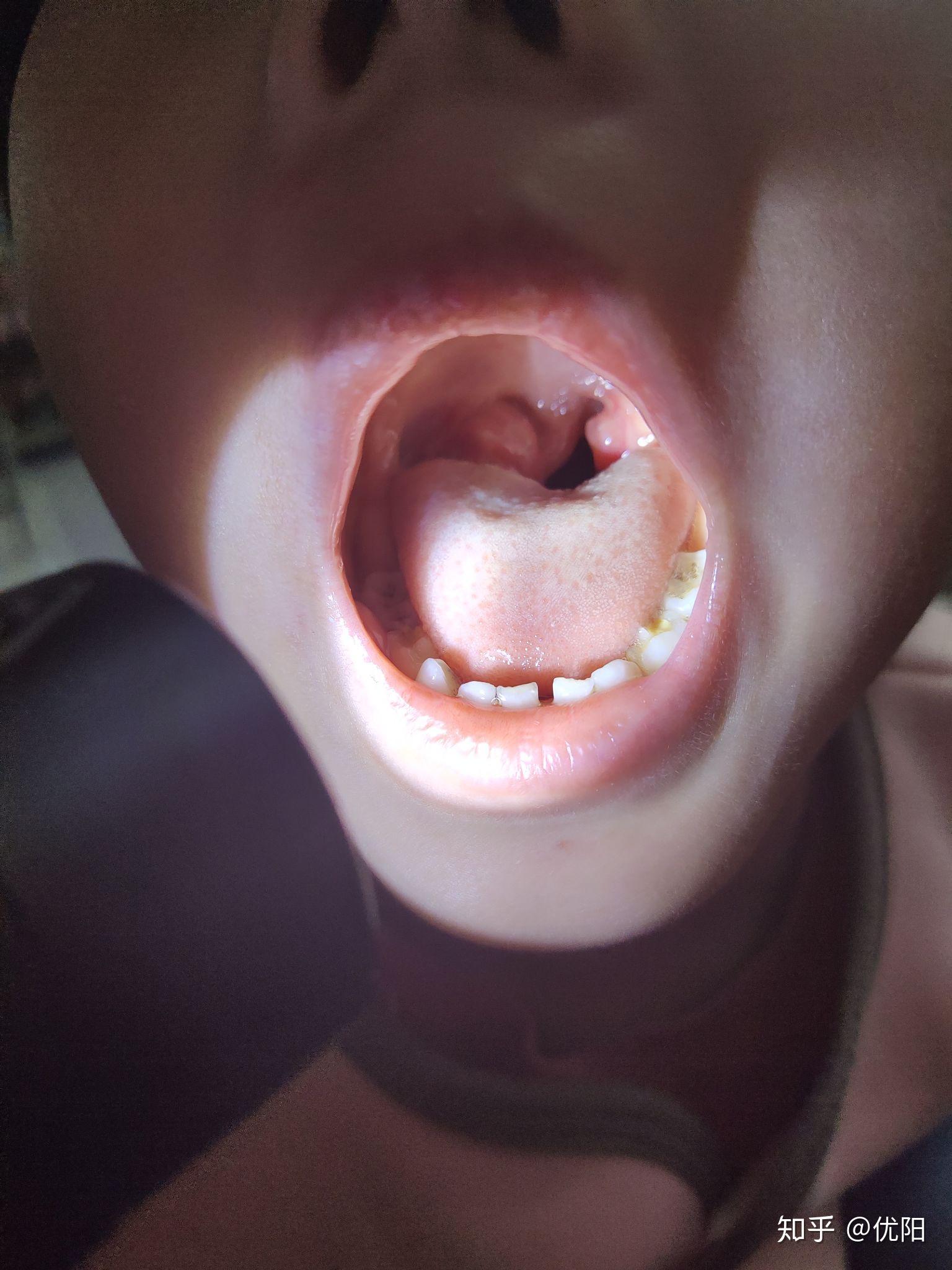 小孩喉咙正常的图片图片