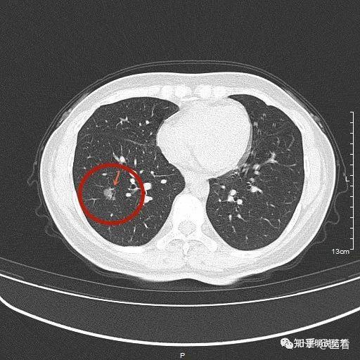 肺結節簡單四分類你不知道的真相