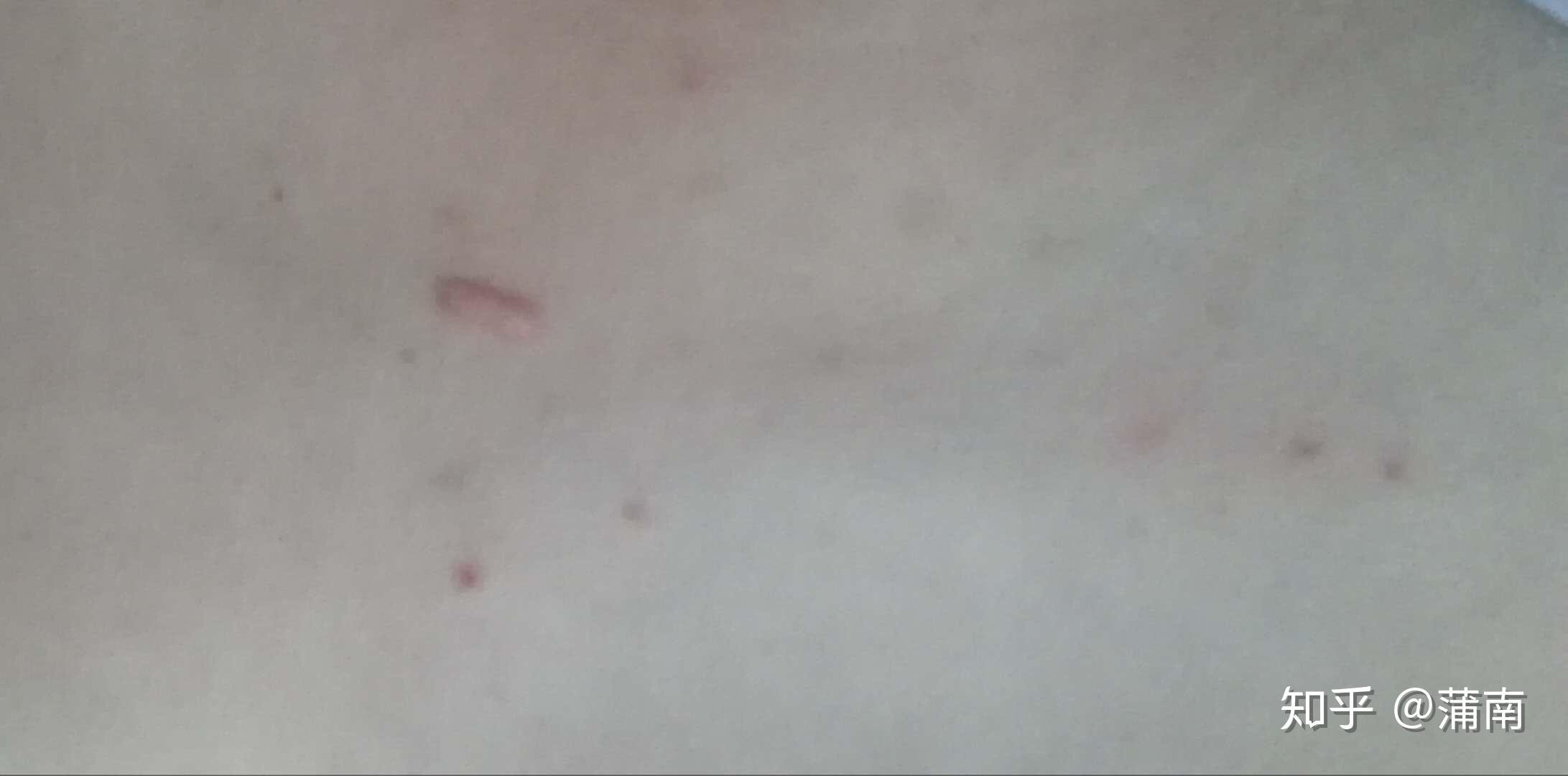 皮肤上凸起的小红点该怎么治疗？ - 知乎