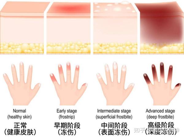 冻疮还能这样做,7天告别冻疮痒、干裂、红肿! - 知乎