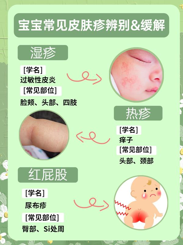 1分钟教你!辨别宝宝常见皮肤疹&缓解方法 - 知乎