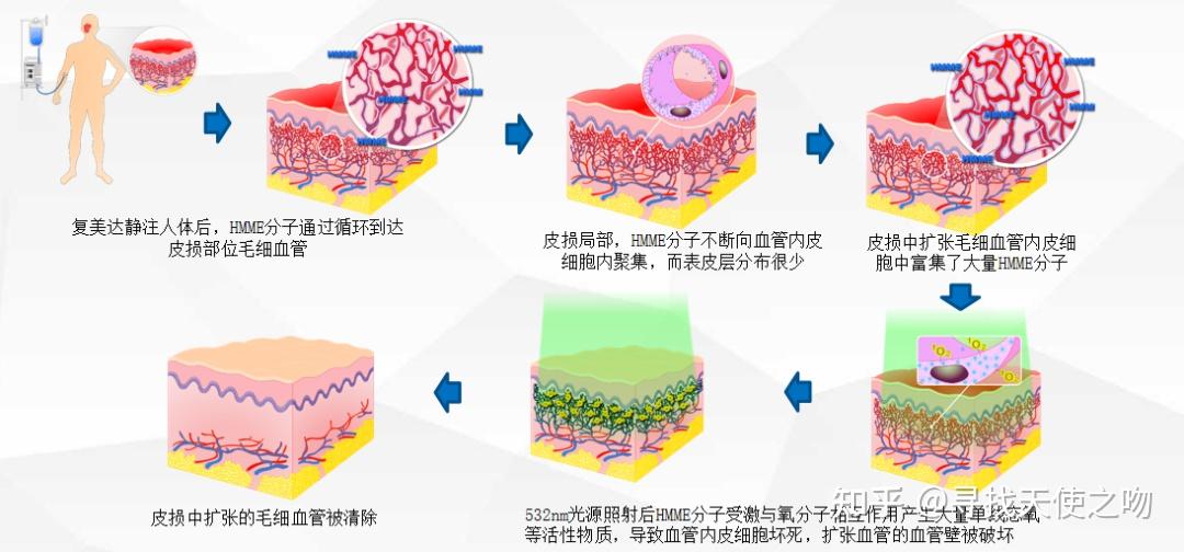 激光和光动力治疗效果差异到底有多大?这张图给你答案! - 知乎