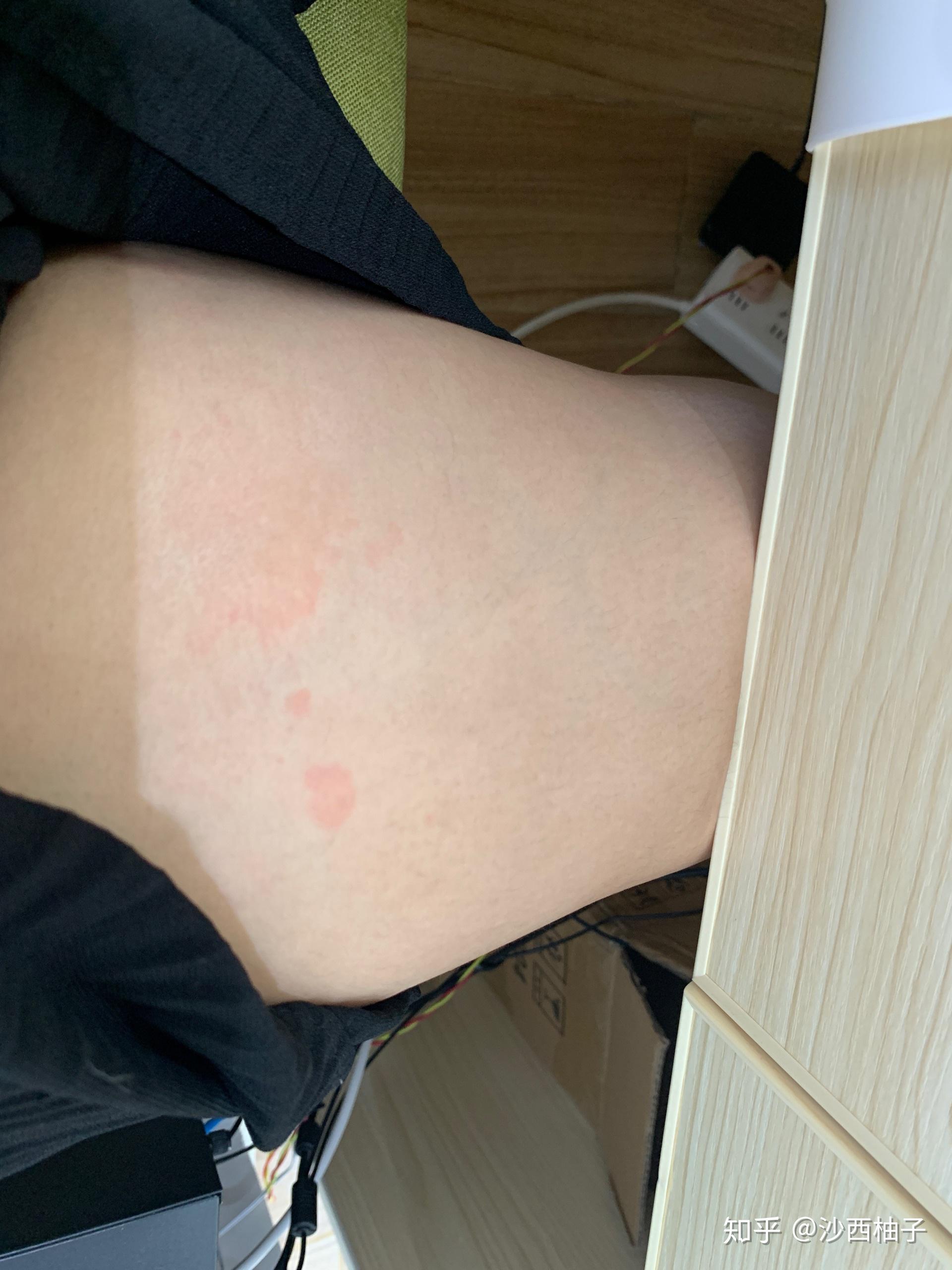 患过3次荨麻疹总结急性慢性