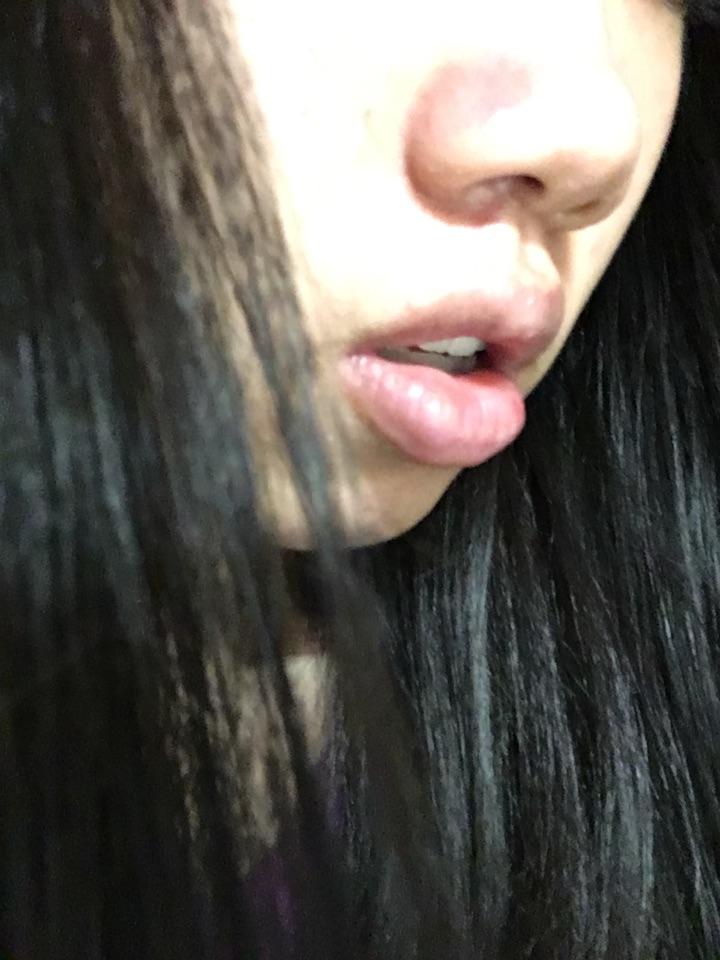 牙齿整齐 但嘴外突 嘴唇超厚 上嘴唇外翻且厚于