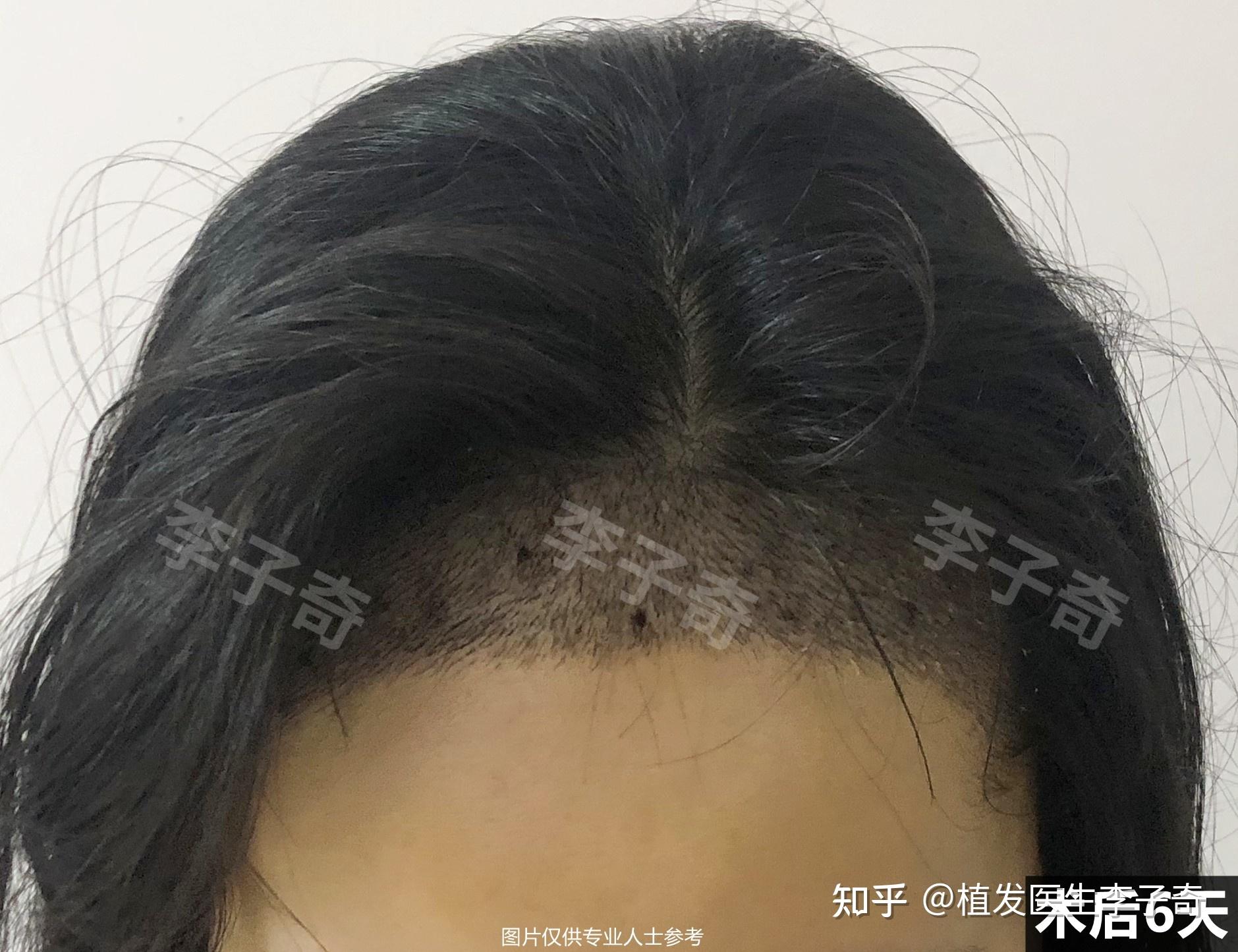北京植发际线一年效果，给你一个植发的理由 - 知乎