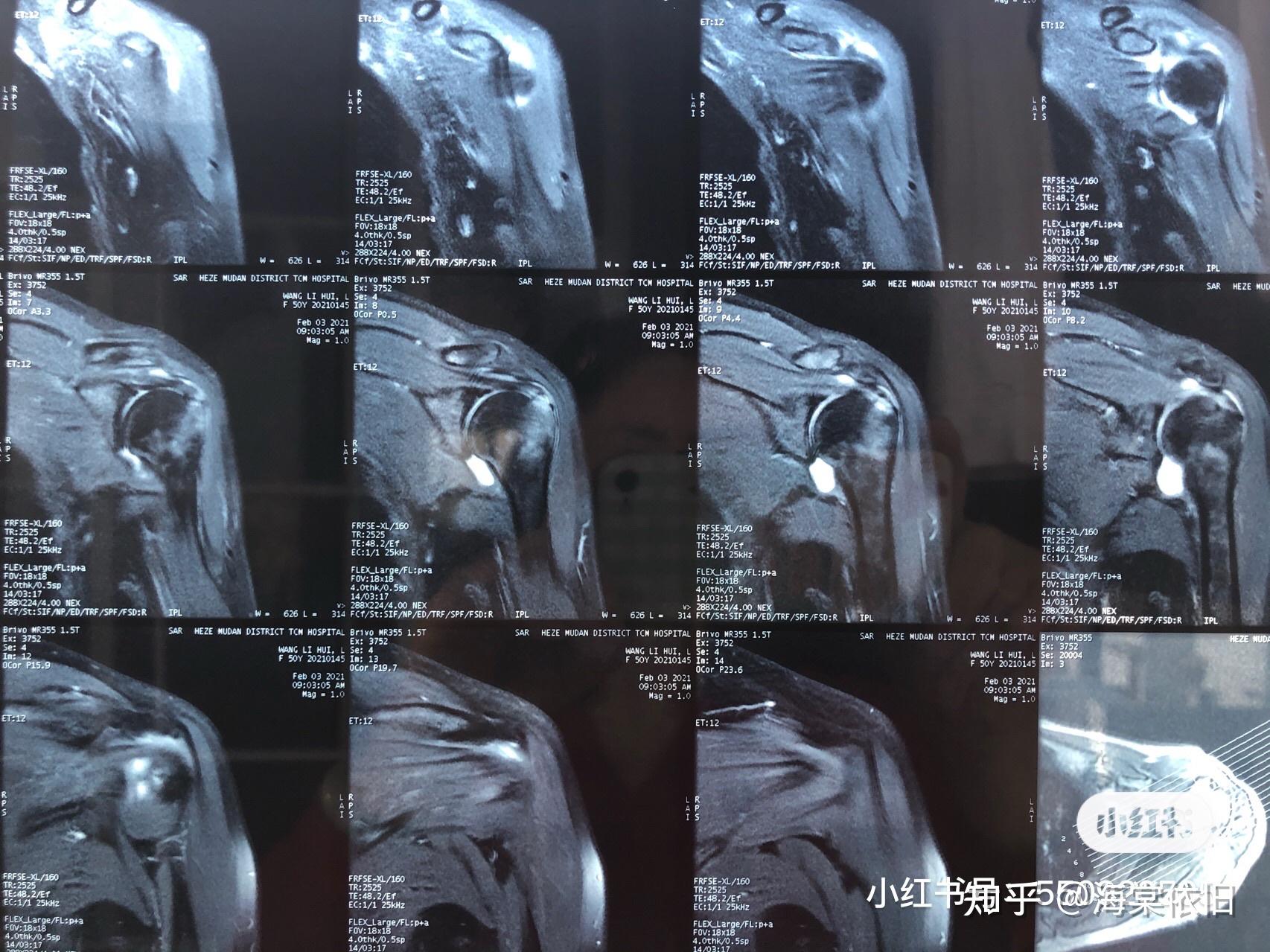 磁共振片子看看骨膜损伤严重吗疼了两个月了晚上休息不好疼醒还几次