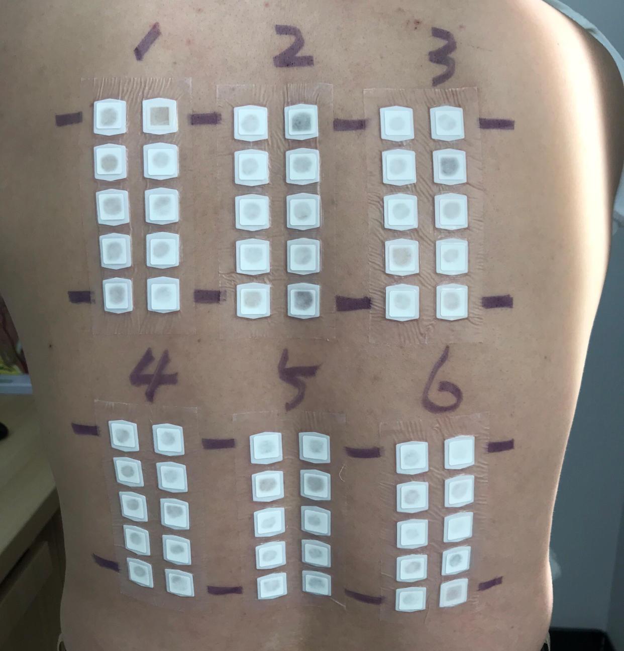 抽血查了食入和吸入性过敏原,同时也做了接触性过敏原也就是斑贴试验