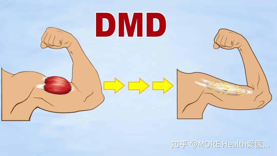 dmd世界知晓日你知道什么是dmd吗