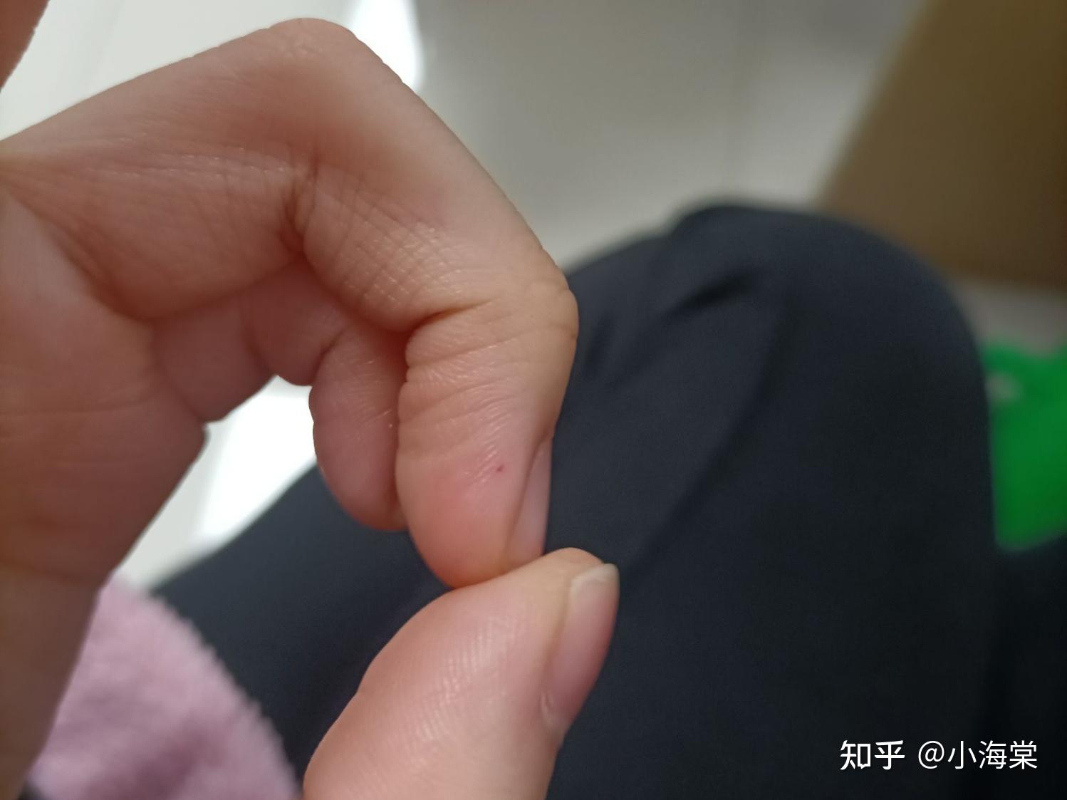 手指肚上长有小红点用指甲按会有针扎的感觉按下去也会让他消失请问