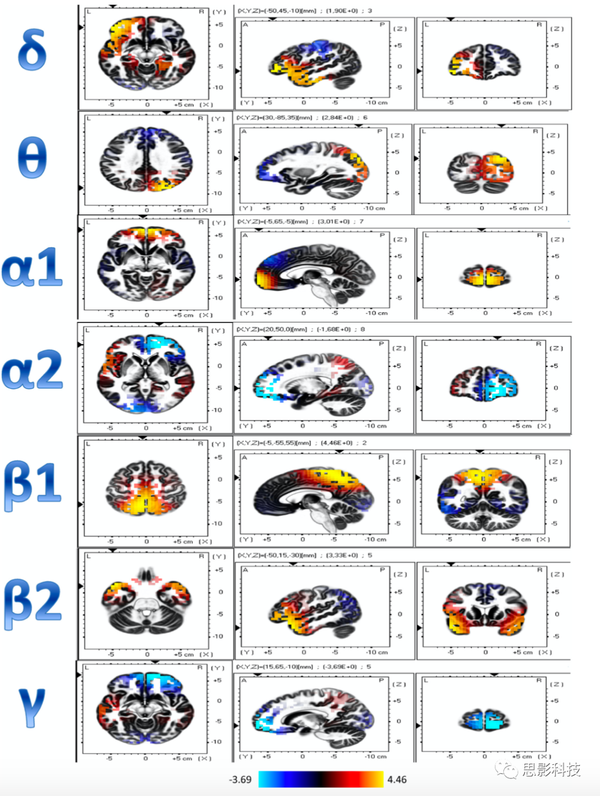 Progress in Neurobiology:慢性抽动障碍和Tourette综合征的脑电功能连接 - 知乎